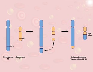 Follicular lymphoma