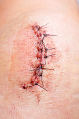 scar from operation with a black fiber - 76021466