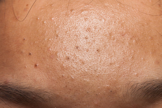 Pimple blackheads on the forehead of an Asian teenager