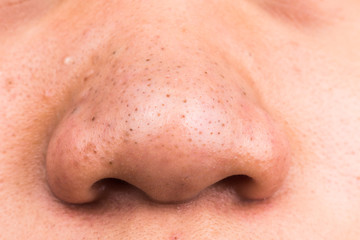 Closed-up pimple blackheads on the nose of an Asian teenager