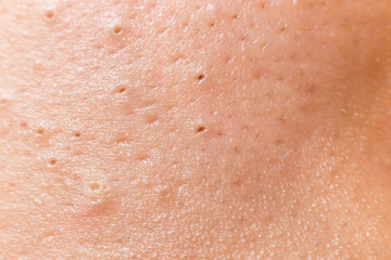 Fototapeta premium Closed-up pimple blackheads on the face of an Asian teenager