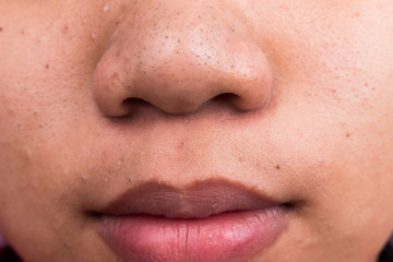 Pimple blackheads on the face of an Asian teenager