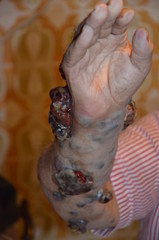 ULCERAS EN TUMOR DE PIEL