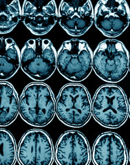 MRI scan image of brain for diagnosis