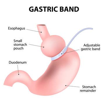 Diagram Of An Adjustable Gastric Band