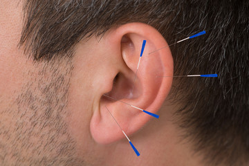 Acupuncture Needles On Ear - obrazy, fototapety, plakaty