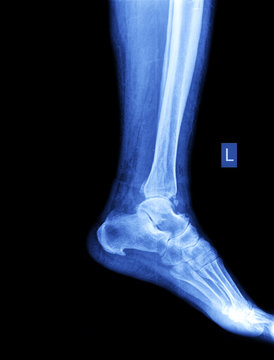 xray of foot by side view