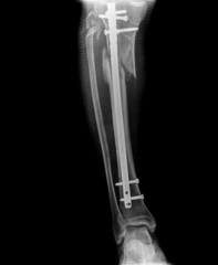 xray of leg with screw