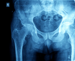 X-ray of the hip