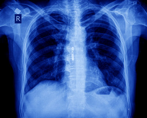 xray of chest