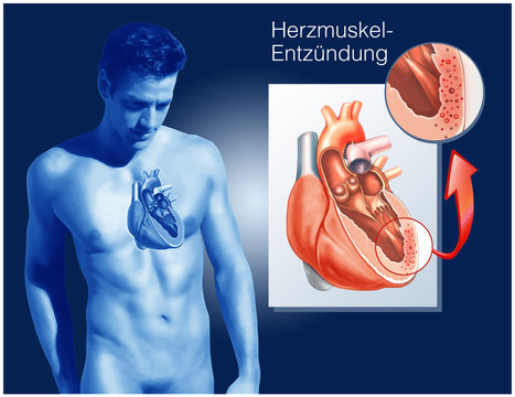 Herzmuskelentz&uuml;ndung.Myokarditis.blau