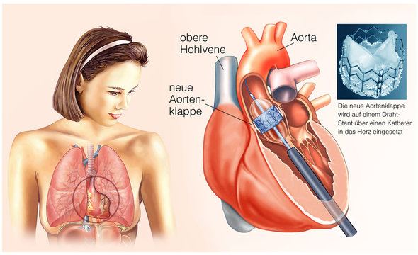 Neue Aortenklappe.Draht-Stent