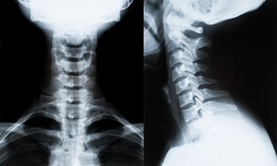 X-ray image of neck