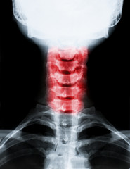 X-ray image of neck