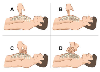 First Aid resuscitation (CPR), massage compression the  chest