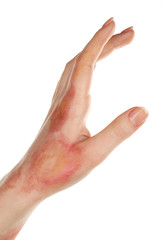 Horrible burns on female hand isolated on white
