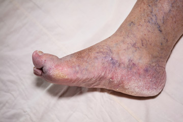 Senior leg problems