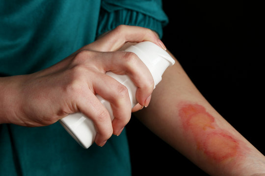 Treatment of burns by spray on female hand on black background