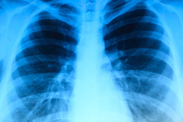X-ray image of chest