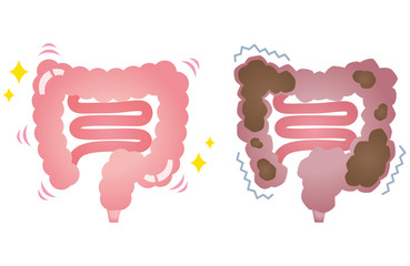 健康な大腸　便秘の大腸 - obrazy, fototapety, plakaty