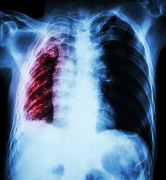 Pulmonary Tuberculosis and Right lung atelectasis