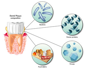placca dentale