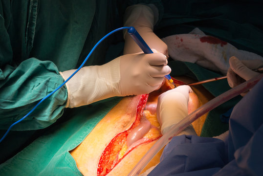 explore laparotomy