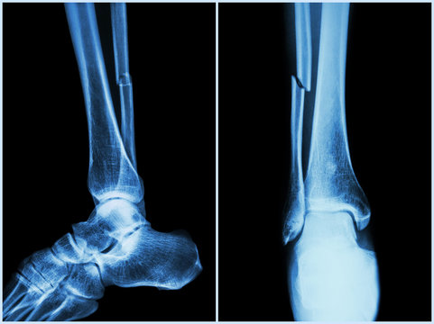 Fracture shaft of fibula bone ( leg bone ) .  X-ray of leg