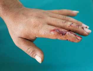 wounded finger with blood dripping