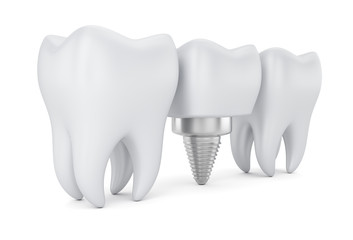 Teeth and dental implant