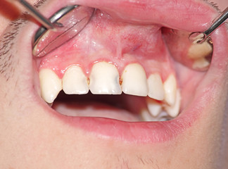 Caries of the upper incisors © DrTI