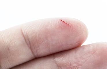 incision wound on finger with white background
