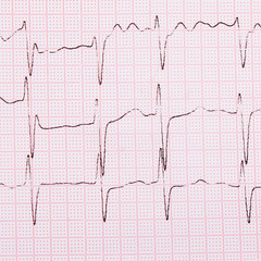 The tape with the cardiogram of a man