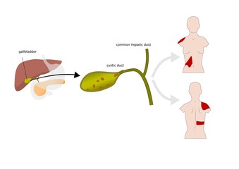 formazione di calcoli biliari, colecistite