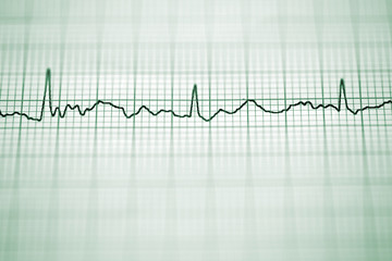 Electrocardiogram