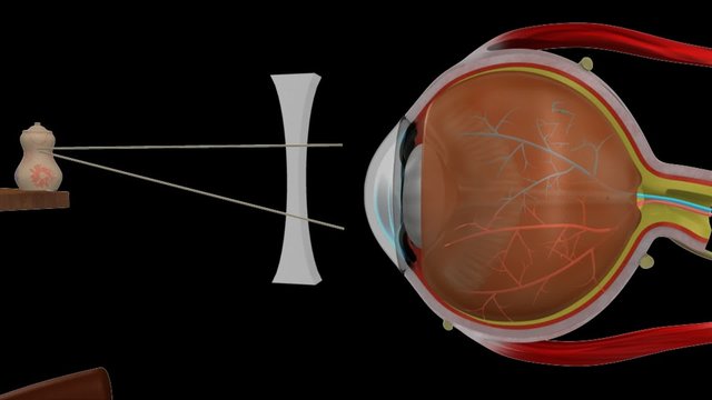 Myopia concave lens