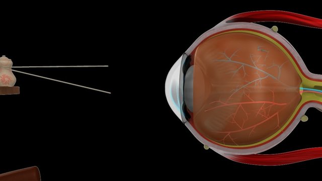 Myopia eye lens