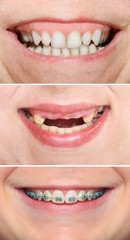 Set of different smiles with teeth.