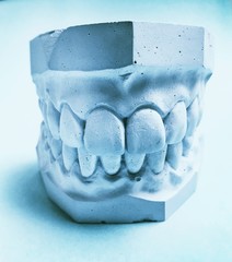 Plaster cast of teeth