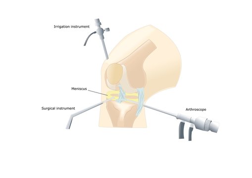 artroscopia del ginocchio, operazione del menisco