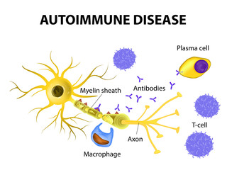 Autoimmune Disease. The mechanisms of neuronal damage in multipl