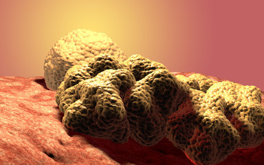 Cancer cell tumor, 3d medical illustration