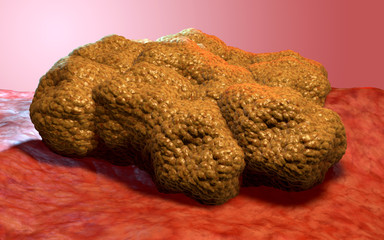 Cancer cell tumor, 3d medical illustration