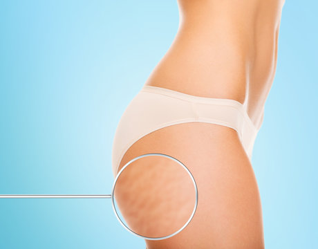 Close Up Of Woman Buttocks With Cellulite