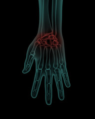 front x-ray view of human painful hand