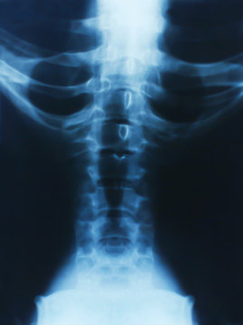 X-ray of the spine close-up