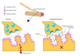 miastenia gravis, malattia autoimmune muscolare