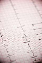 Electrocardiogram