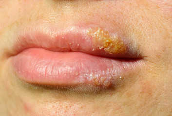 Fototapeta premium Herpes