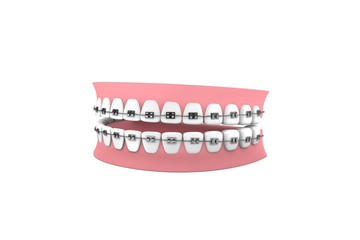 Zahnspange-Kieferorthopädie